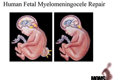 also called Spina Bifida Cystica