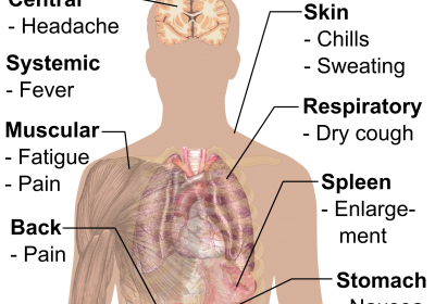 Symptoms of Malaria