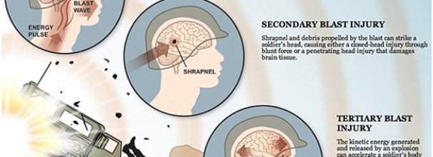 Traumatic Brain Injury (TBI)